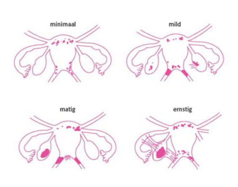 Wat is endometriose? Behind Endo